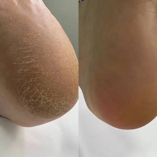 Кератолітик для стоп на сечовині 20%, 100 мл Podology+ NAILSOFTHEDAY