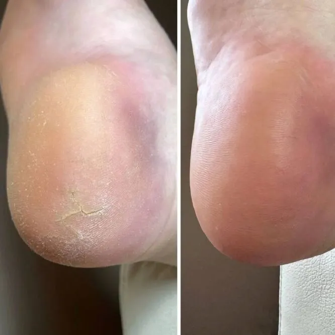 Крем від тріщин на шкірі рук та стоп з сечовиною 12%, 30 мл Podology+ NAILSOFTHEDAY